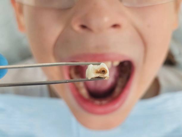 Best Same-Day Emergency Dentist in Columbia City, IN